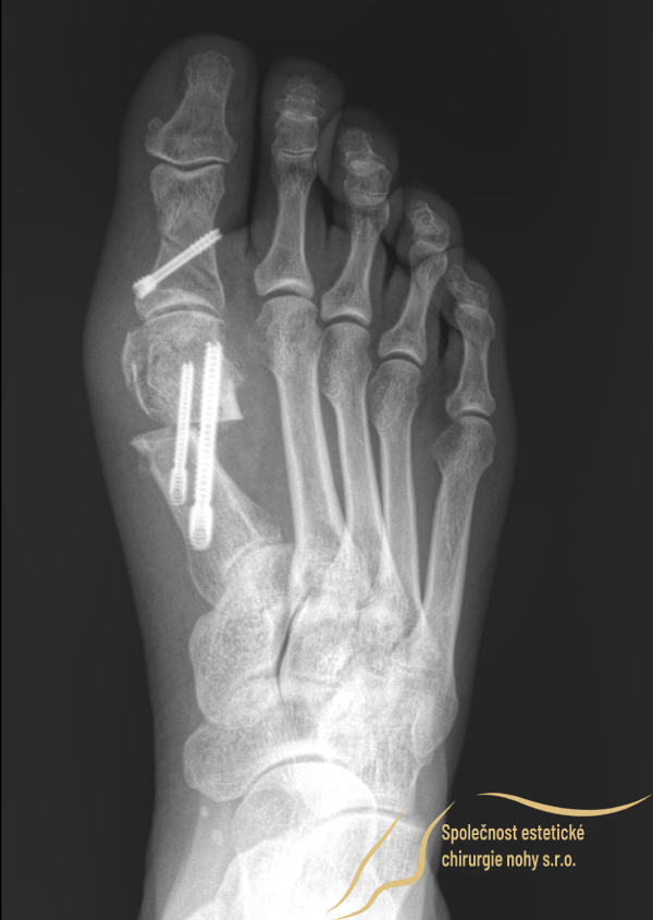 Postoperative X-ray of a bunion